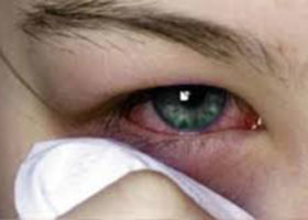 CONJUNTIVITIS